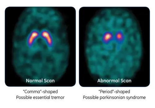 Two DaTscan images side by side: a normal scan with even, comma-shaped activity on both sides, and an abnormal scan where one side has collapsed into a period shape
